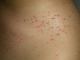 乱用脱毛膏小心毛囊炎找上门