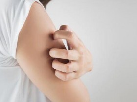 荨麻疹发作好难受 做对3招快速止痒