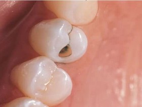 爱牙就防龋齿 保护正常咀嚼功能，方可延缓老化