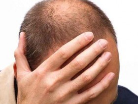 白发多、狂掉发?必吃这些黑色食物护发