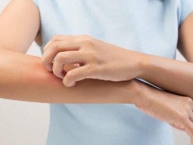 皮肤起红疹痒个不停…遇到药物过敏该怎麽办