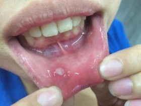 嘴破居然只要用 这个漱口立刻好