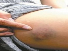 动不动就瘀青 原来是这个器官在呼救,现在知道还不算晚啊