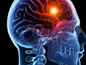 脑中风急救有新疗法 动脉取栓降低后遗症