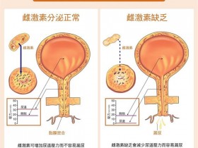 更年期尿失禁、泌尿感染困扰缠身，怎么办？