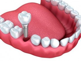 根管治疗后为何又蛀牙?