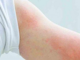 防荨麻疹发作,少喝咖啡、奶茶3饮品,是真是假