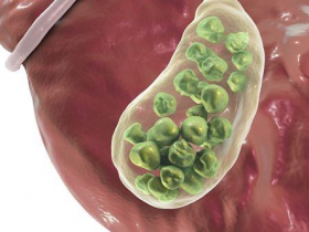 早餐没吃容易胆结石?营养师这样说