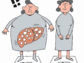 爱吃甜食、水果、不运动,都是危险群 爱吃水果的瘦子,也会有脂肪肝