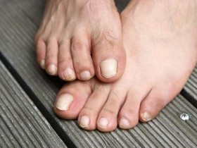 消灭香港脚、灰指甲~6步防霉大作战