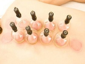 拔罐减肥有这么简单?中医师:主排毒活血
