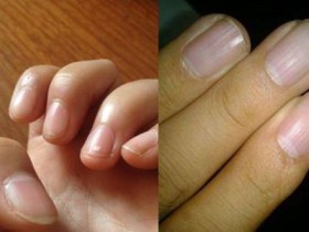 手指甲上有竖纹是怎么回事？表示你的身体出了问题