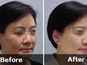 拉皮除皱多少钱?十年后情况怎样?