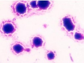 解脲支原体感染的危害有哪些?原因是什么?如何治疗?