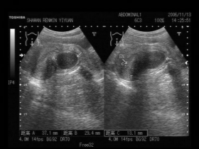 宫颈多发纳氏囊肿能自愈吗,会癌变吗,吃什么药好?