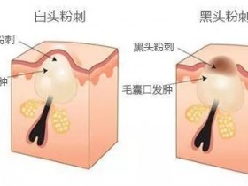 毛孔粗大有黑头怎么办?如何专治毛孔粗大?