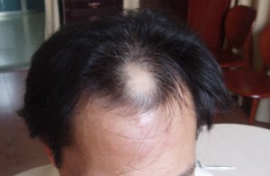 脱发可能是五种病导致