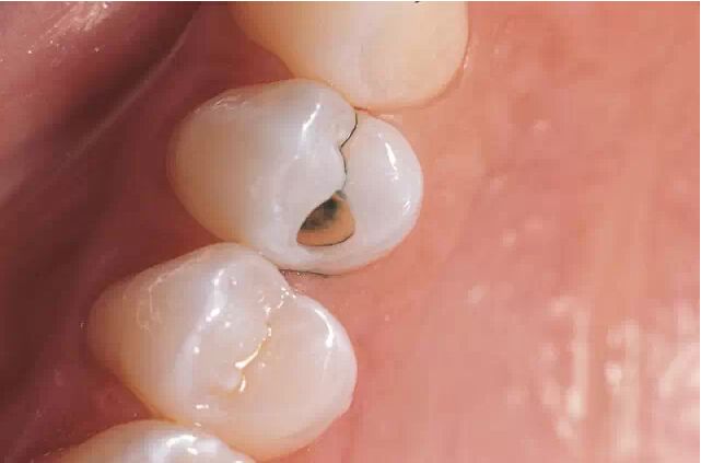 爱牙就防龋齿 保护正常咀嚼功能，方可延缓老化