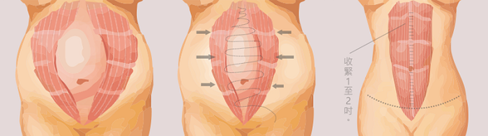 小腹松垮垮的！腹部拉皮让您重拾产前光彩