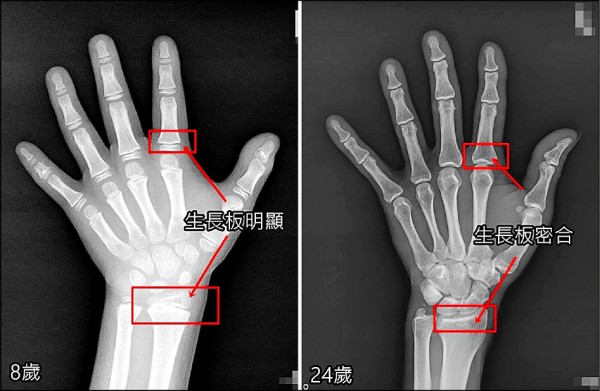 长高贴片能二次发育？医生：假的，别上当！